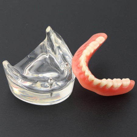 Tandentandenmodel Overdenture Inferieur met 2 implantaten Studiedemo Model 6002 01