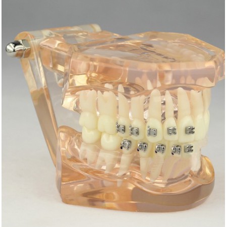 Tandheelkundig Orthodontisch model met keramische beugels M3009