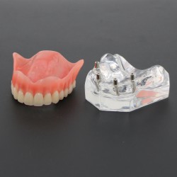 Tandheelkundige studie Tanden Model Overdenture Superior met 4 implantaten Demo Model 6001