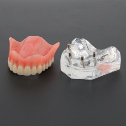 Tandheelkundige studie Tanden Model Overdenture met 4 implantaten Demo Model 6001