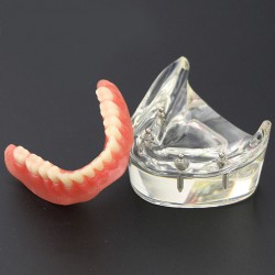 Demo-onderzoek tandheelkundige onderste tanden Model 6002 02 Overdenture Inferior 4 implantaten