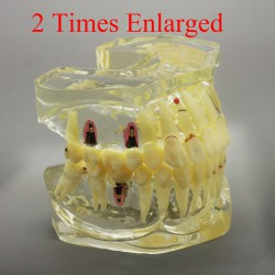2 maal vergroot tandherstel / prothese / implantaat Studiemodel met brug
