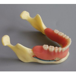 Tandheelkundig Model # 2014 02 - Demible Model Mandible Implant and Overdenture (Geel)