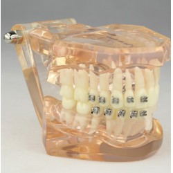 Tandheelkundig Orthodontisch model met keramische beugels M3009