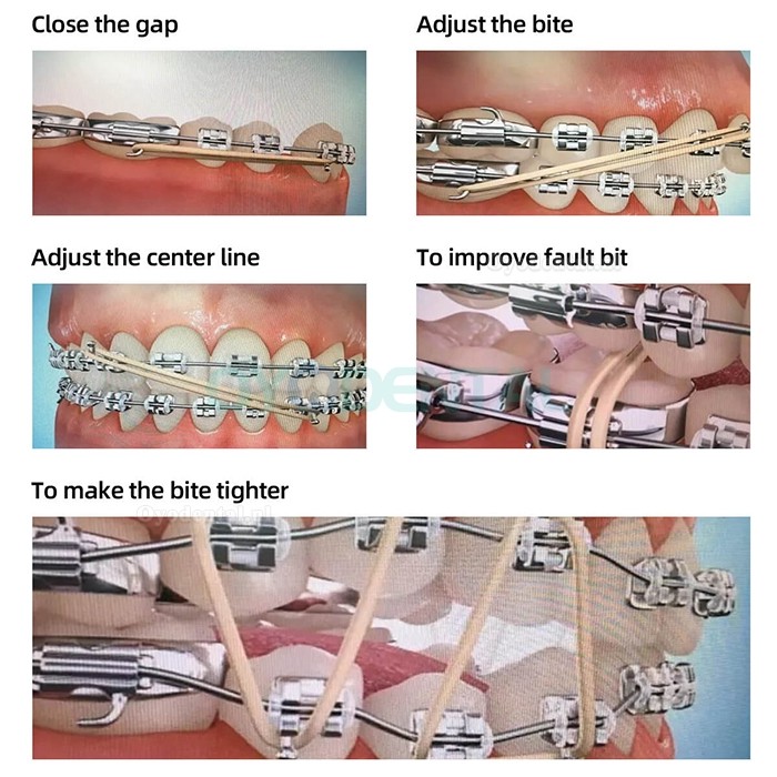 1000 stuks tandheelkundige orthodontische elastiekjes ortho-elastieken latex beugels 15 maten