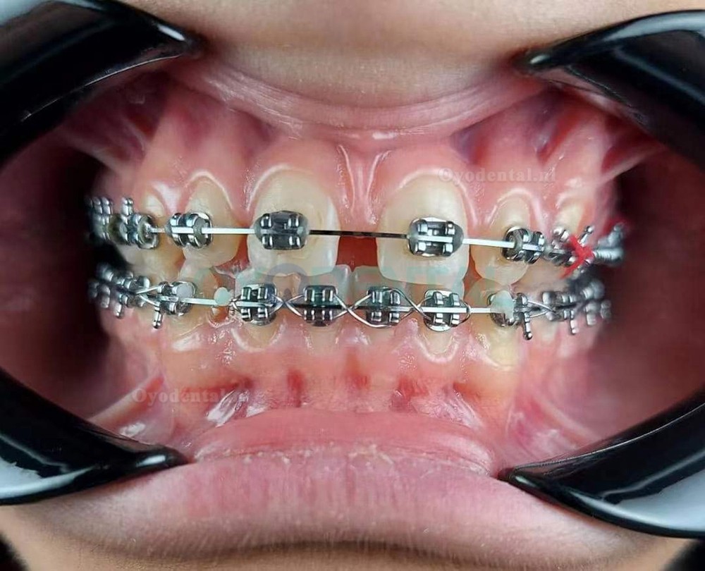 Tandheelkundige aanpassing Orale fotografie Flitslicht Mobiele telefoon Tandheelkundige fotografie Invullicht