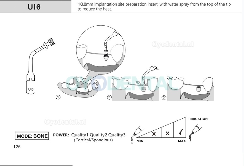 1Pcs Tips voor tandheelkundige piëzochirurgie voor botsnijden sinus lifting implantaat Ul1 UI2 UI3 UI4 UI5 compatibel met Mectron Woodpecker