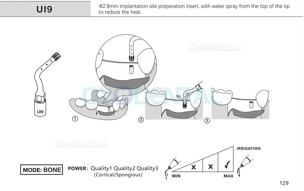 1Pcs Tips voor tandheelkundige piëzochirurgie voor botsnijden sinus lifting implantaat Ul1 UI2 UI3 UI4 UI5 compatibel met Mectron Woodpecker