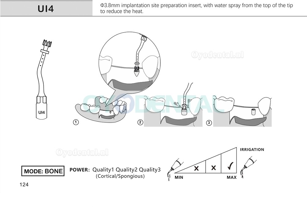 1Pcs Tips voor tandheelkundige piëzochirurgie voor botsnijden sinus lifting implantaat Ul1 UI2 UI3 UI4 UI5 compatibel met Mectron Woodpecker