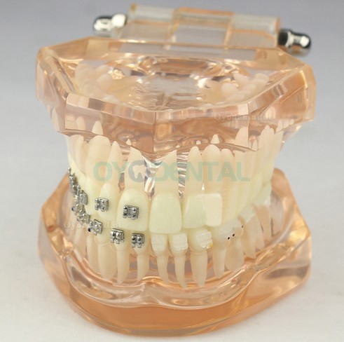 Tandheelkundig Orthodontisch model met keramische beugels M3009
