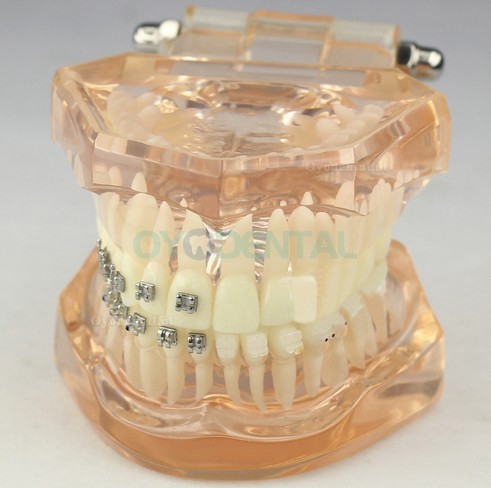 Tandheelkundig Orthodontisch model met keramische beugels M3009