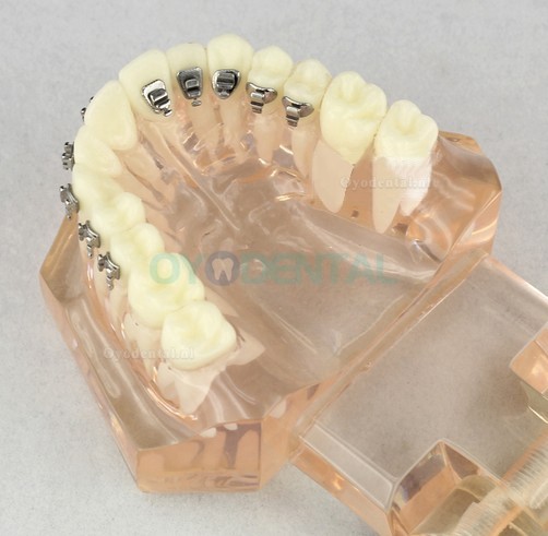 Tandheelkundig Orthodontisch model met keramische beugels M3009