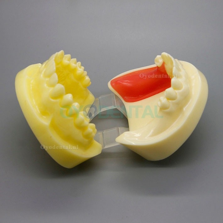 Tandheelkundige implantaatboorkaak Typodont met verwijderbare tandvlees 2002