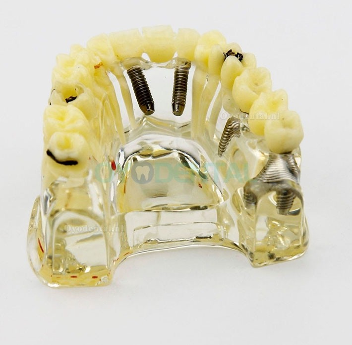 Tandheelkundig implantaat Typodont-model met brug en cariës Bovenkaaktandenmodel