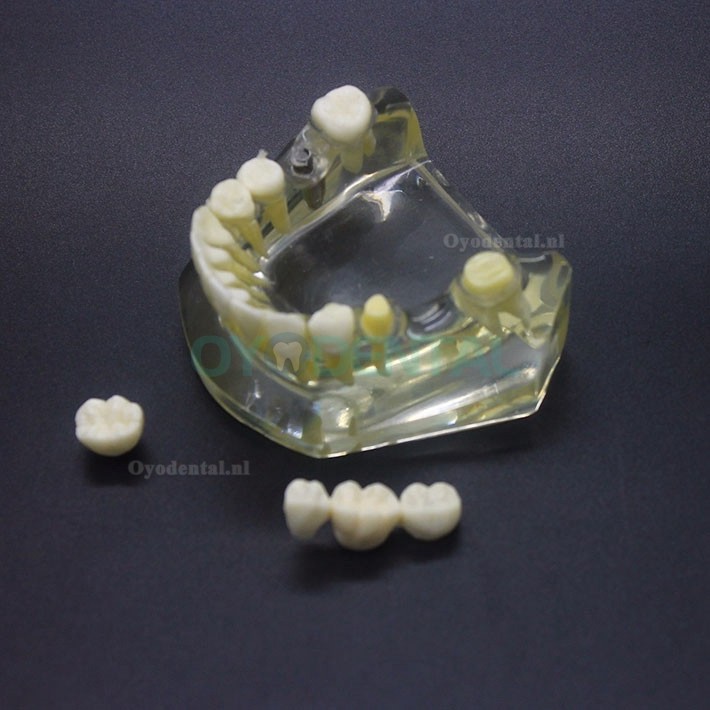 Onderzoek naar tandheelkundige implantaten Typodont-model Onderkaak Crown Bridge 2010