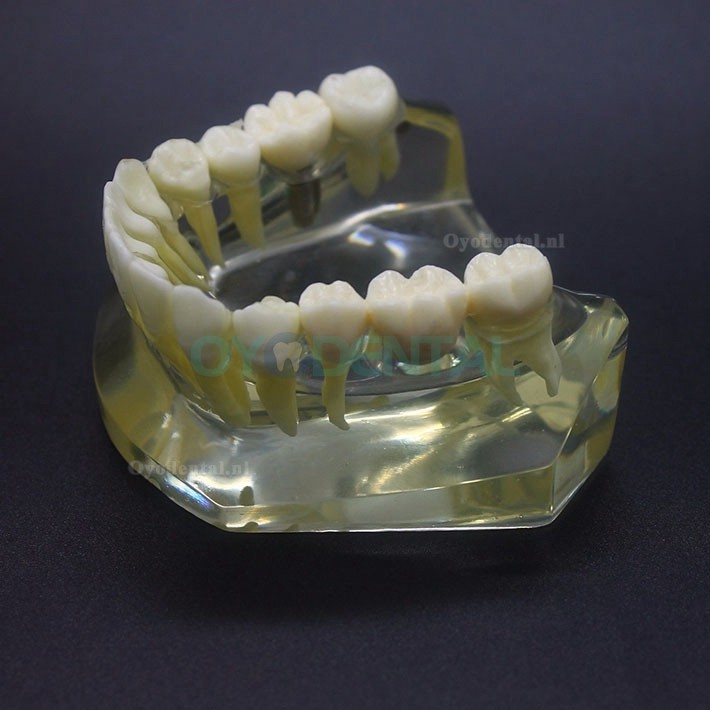 Onderzoek naar tandheelkundige implantaten Typodont-model Onderkaak Crown Bridge 2010