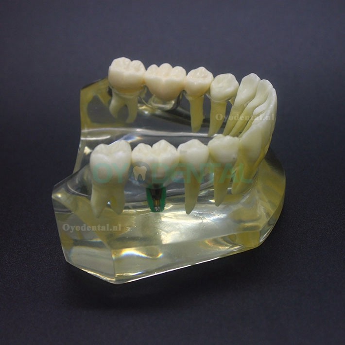 Onderzoek naar tandheelkundige implantaten Typodont-model Onderkaak Crown Bridge 2010