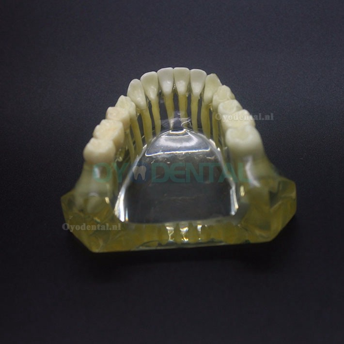 Onderzoek naar tandheelkundige implantaten Typodont-model Onderkaak Crown Bridge 2010