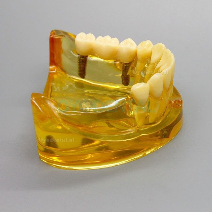 Tandheelkundige onderkaakimplantaat model 2011 met 2 implantaatbruggen
