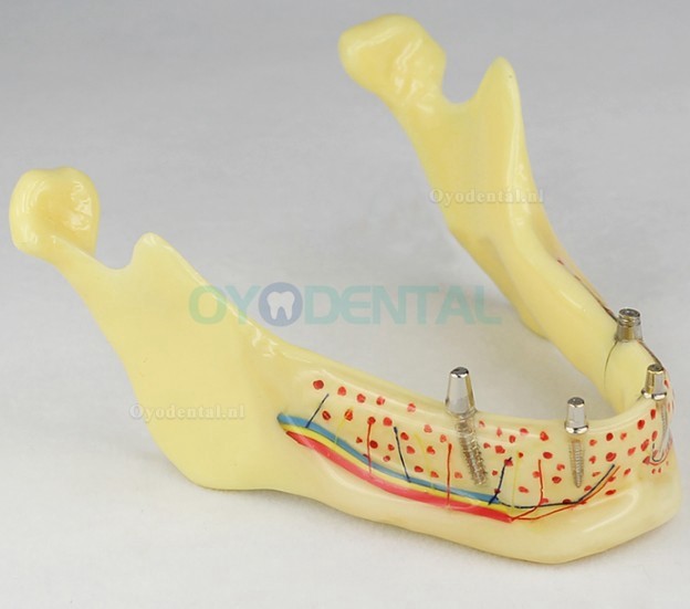 Tandheelkundige tanden Implantaatmodel Jaw M-2014B