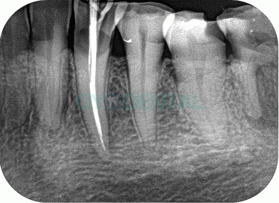 Fussen F200 tandheelkundige fosforplaatscanner Röntgenbeeldvorming PSP-scanner