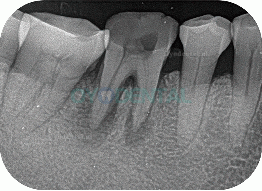 Fussen F200 tandheelkundige fosforplaatscanner Röntgenbeeldvorming PSP-scanner