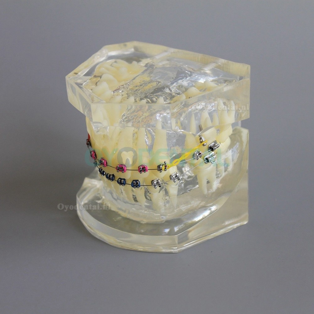 Tandheelkundige Orthodontische demonstratie praktijkmodel met metalen beugel Archwire