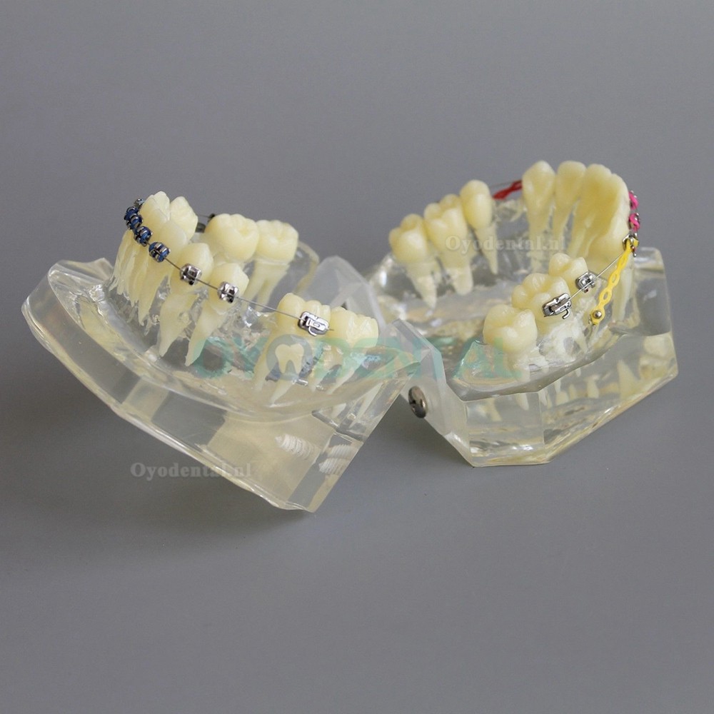 Tandheelkundige Orthodontische demonstratie praktijkmodel met metalen beugel Archwire