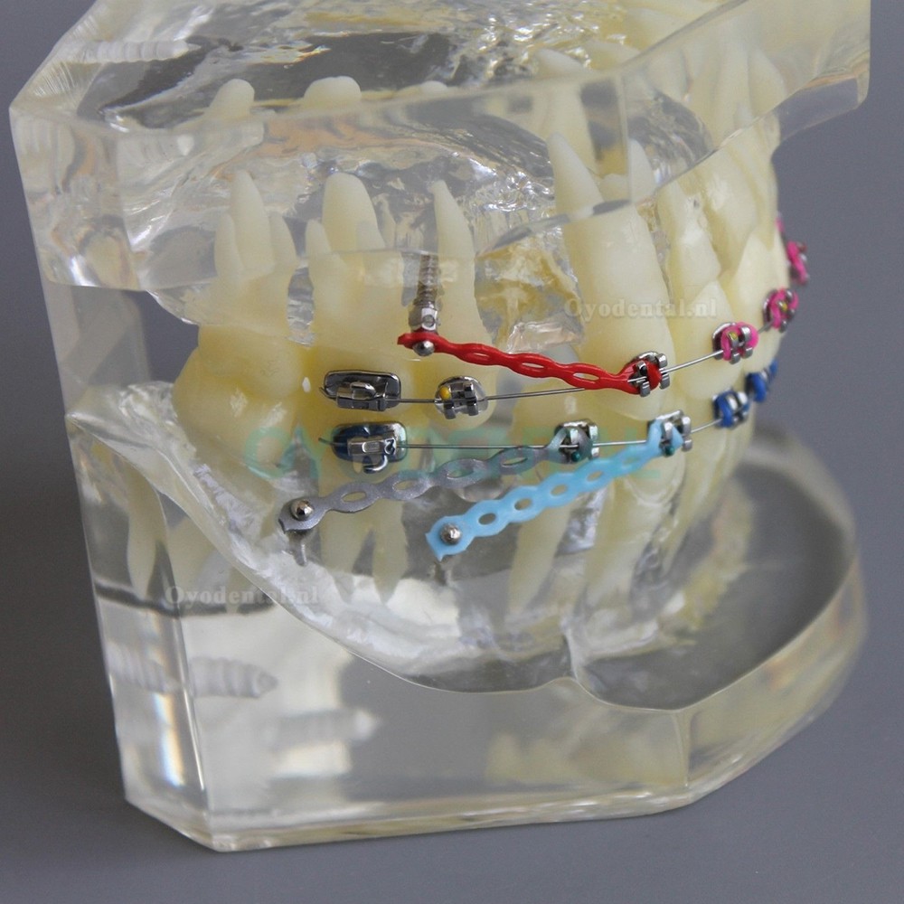 Tandheelkundige Orthodontische demonstratie praktijkmodel met metalen beugel Archwire