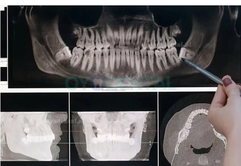 Refine MaxSurgery Tandheelkundig piëzochirurgiesysteem Ultrasoon piëzo-botchirurgiesysteem Piezo-chirurgiemachine