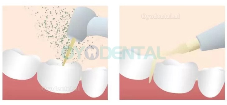 Refine MaxSurgery Tandheelkundig piëzochirurgiesysteem Ultrasoon piëzo-botchirurgiesysteem Piezo-chirurgiemachine