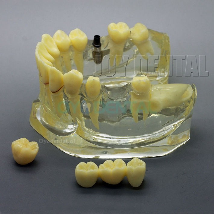 2 maal vergroot tandherstel / prothese / implantaat Studiemodel met brug