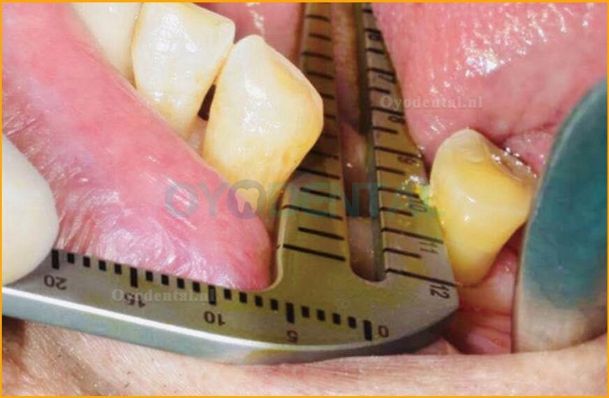 Gidsenset voor tandheelkundige implantaten roestvrij staal oraal planten positionering instrument hoekliniaal
