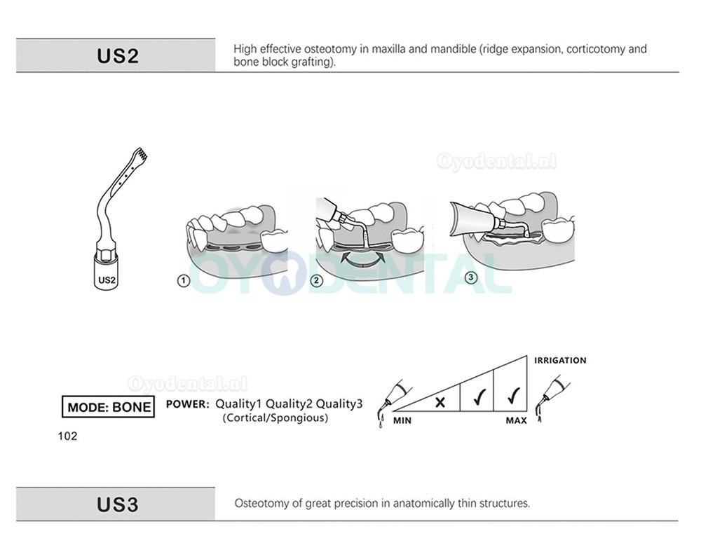 1Pcs Ultrachirurgische tips Bot snijden US1 US1L US1R US2 US3 US4 US5 US6 US7 US11 US12 compatibel met Mectron