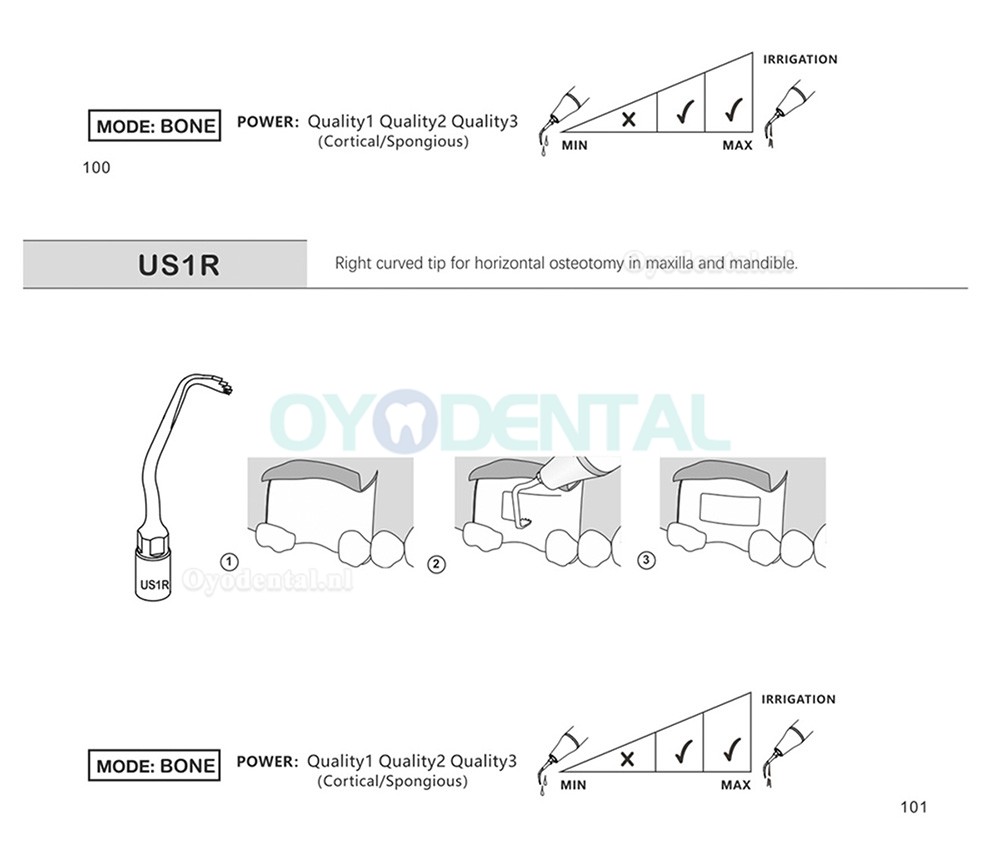 1Pcs Ultrachirurgische tips Bot snijden US1 US1L US1R US2 US3 US4 US5 US6 US7 US11 US12 compatibel met Mectron