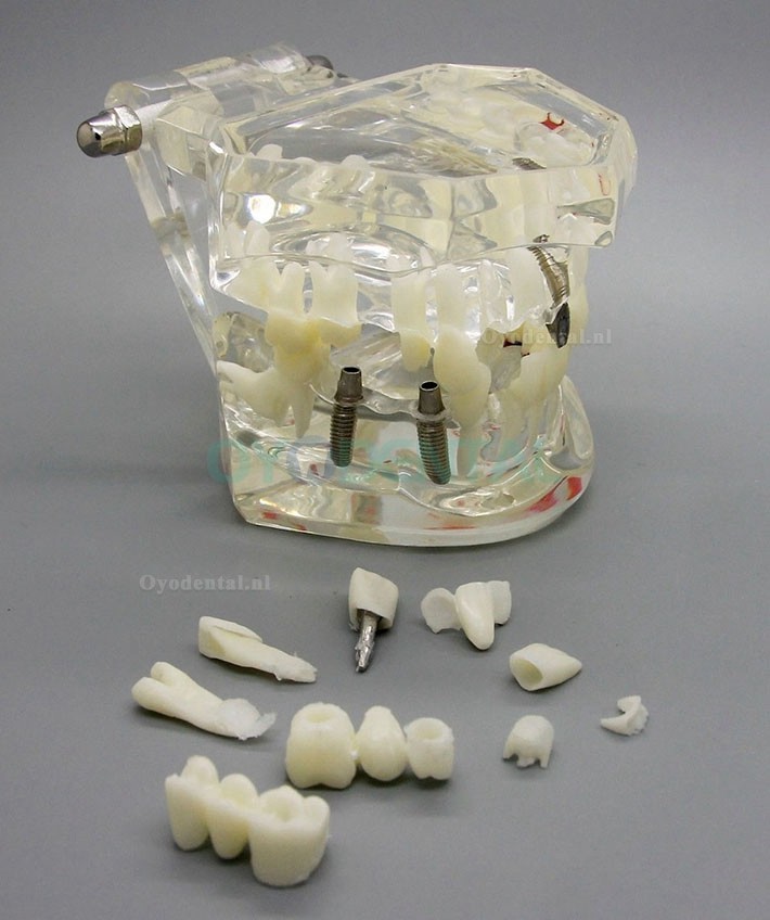 Dental Analyse van implantaatonderzoek Demonstration Teeth Disease Model met Restoration