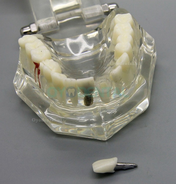 Dental Analyse van implantaatonderzoek Demonstration Teeth Disease Model met Restoration