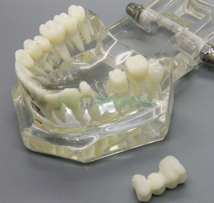 Dental Analyse van implantaatonderzoek Demonstration Teeth Disease Model met Restoration