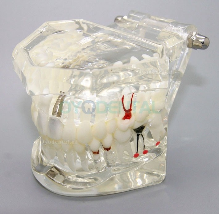 Dental Analyse van implantaatonderzoek Demonstration Teeth Disease Model met Restoration