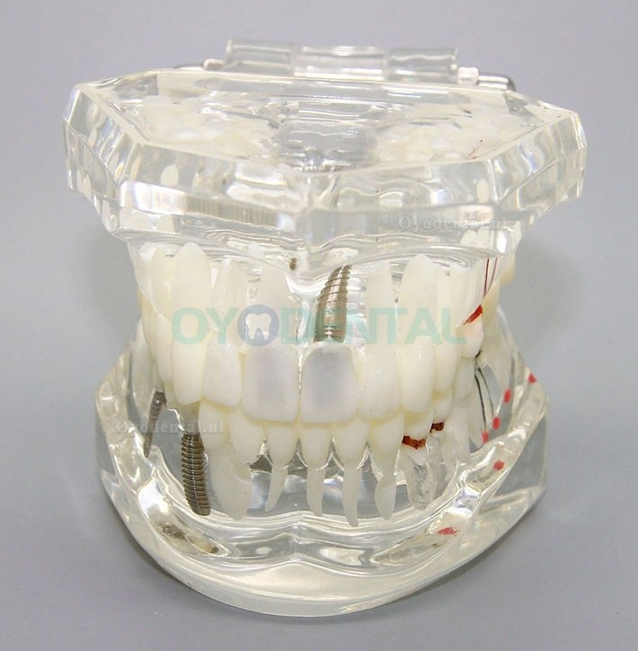 Dental Analyse van implantaatonderzoek Demonstration Teeth Disease Model met Restoration