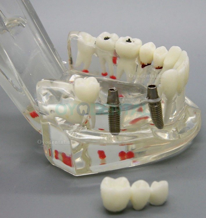 Dental Analyse van implantaatonderzoek Demonstration Teeth Disease Model met Restoration