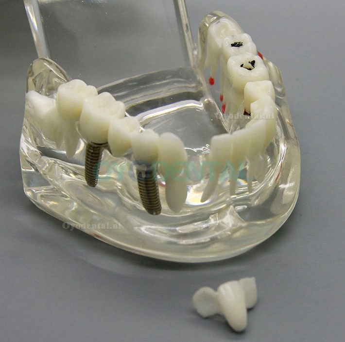 Dental Analyse van implantaatonderzoek Demonstration Teeth Disease Model met Restoration