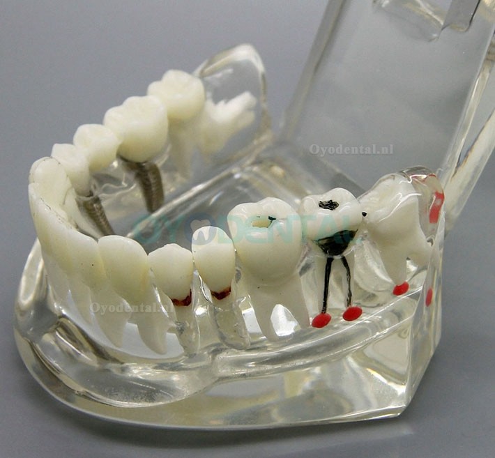 Dental Analyse van implantaatonderzoek Demonstration Teeth Disease Model met Restoration