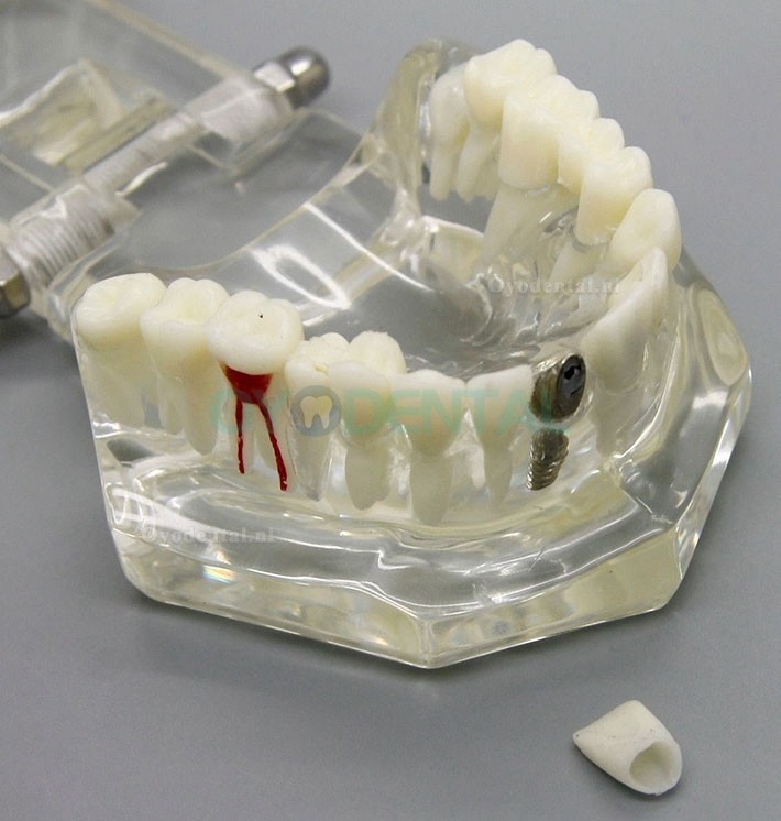 Dental Analyse van implantaatonderzoek Demonstration Teeth Disease Model met Restoration