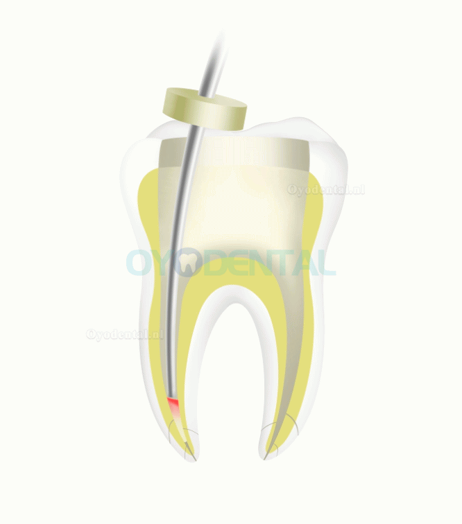 Woodpecker Fi-P Dental Wireless Guttapercha endodontische obturatiepen