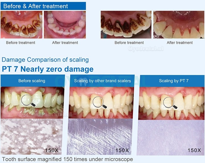 Refine PT 7 Ultrasone scaler met reservoir slimme controle automatische watertoevoer